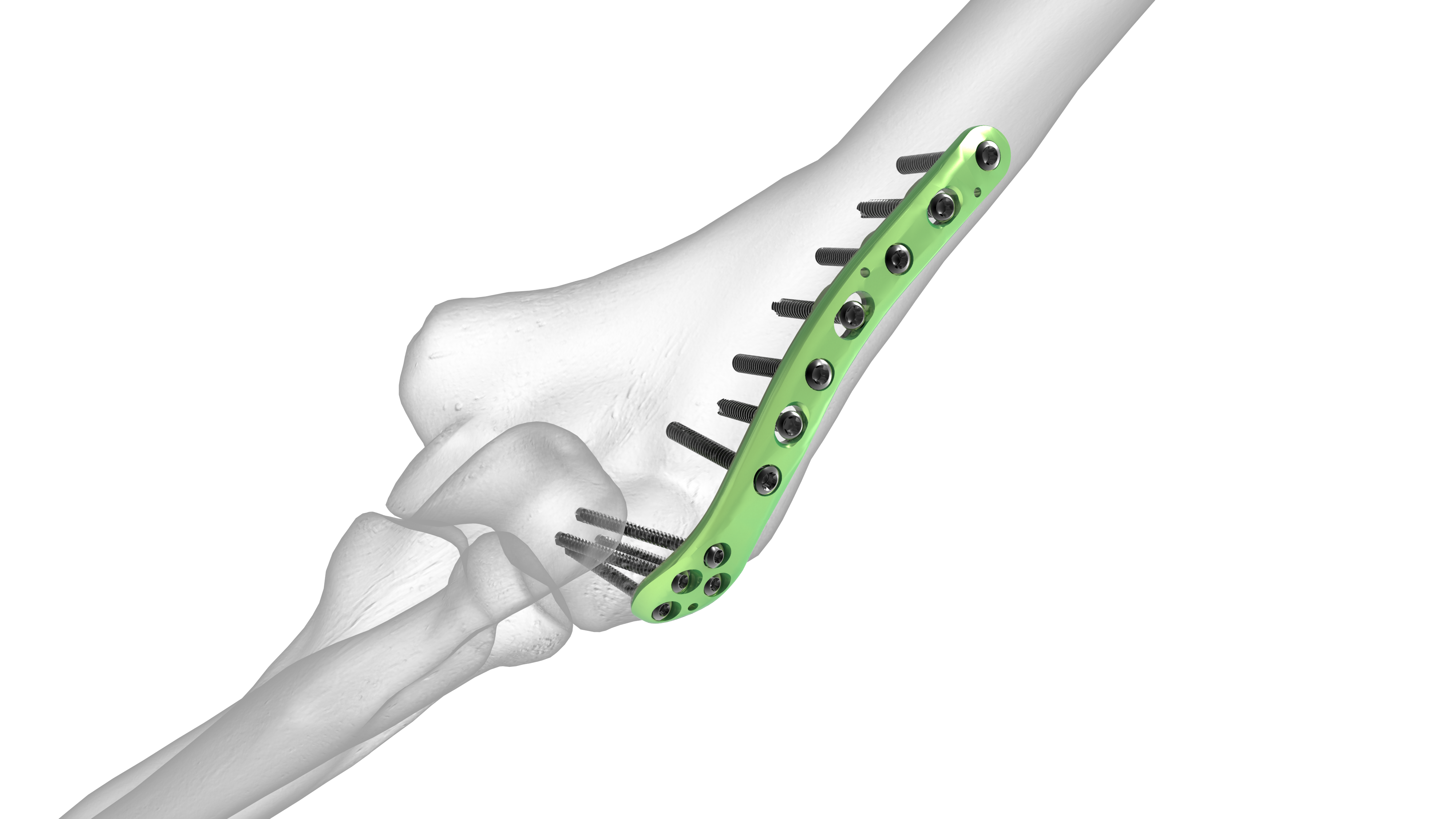 Posterolateral Plate Acumed