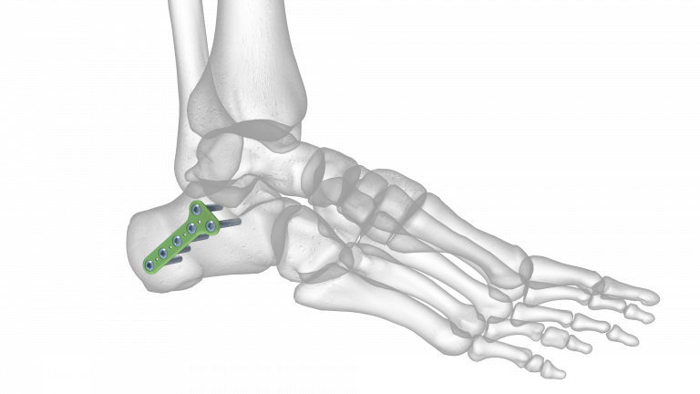 Posterior Tuberosity Plate | Acumed