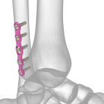 Ankle Plating System | Acumed