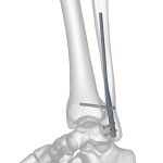 Fibula Rod System | Acumed