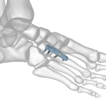 Forefoot-Midfoot Plating System | Acumed