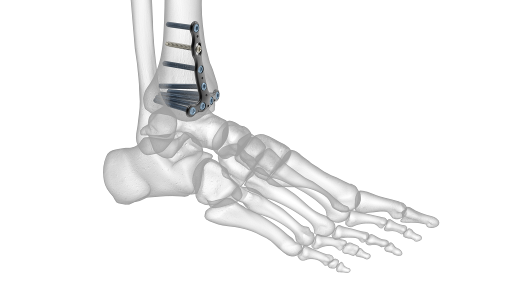 Locking Ankle Plating System | Acumed