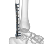 Ankle Plating System | Acumed