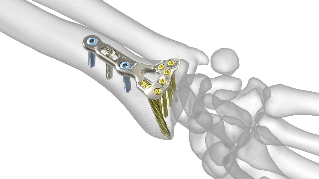 Standard Vdr Plate Acumed