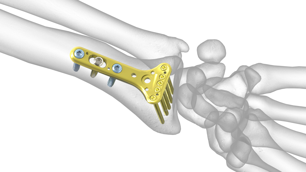 Acu-Loc Wrist Plating System | Acumed