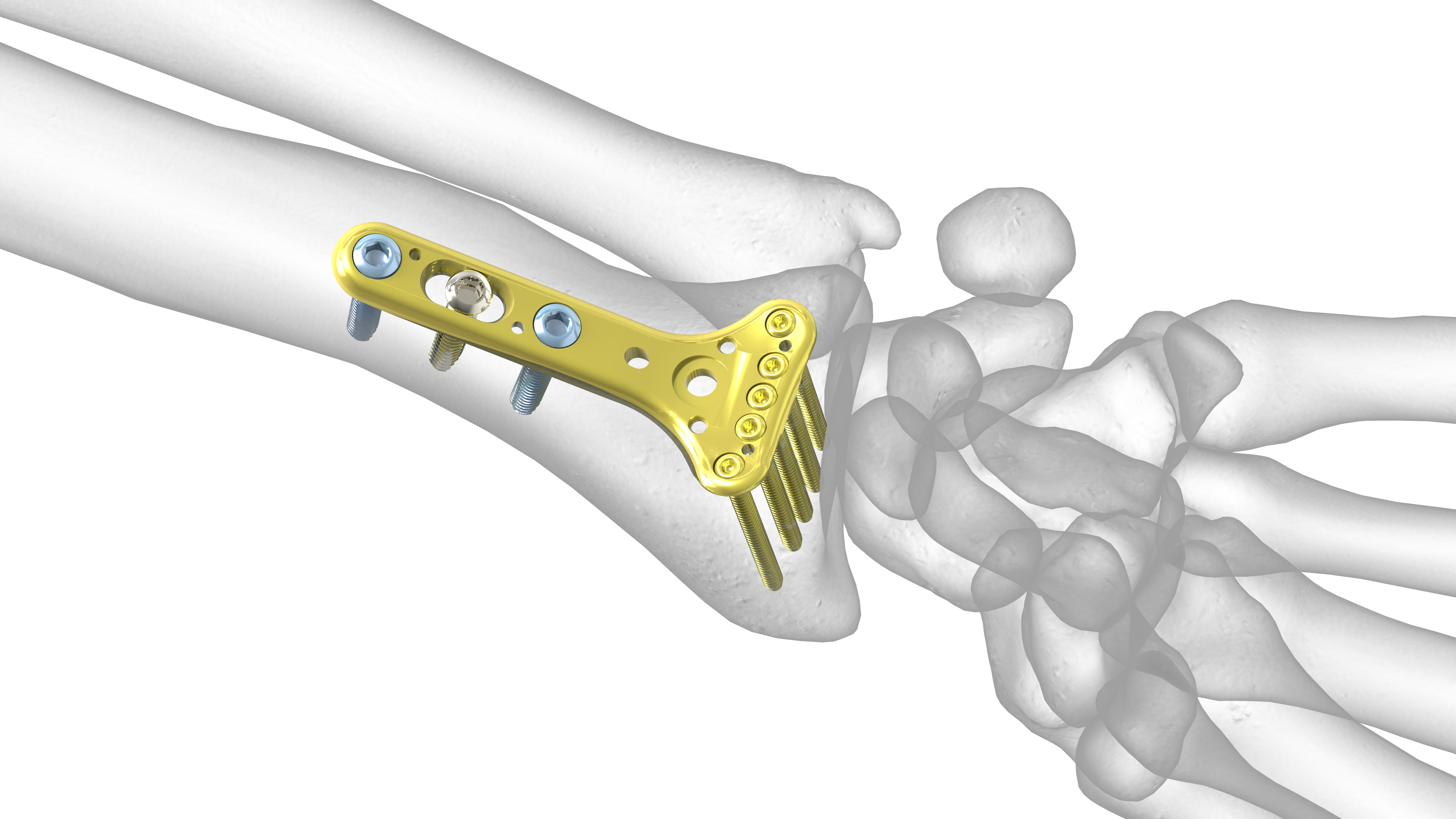 Extra-Articular (EX) Plate | Acumed