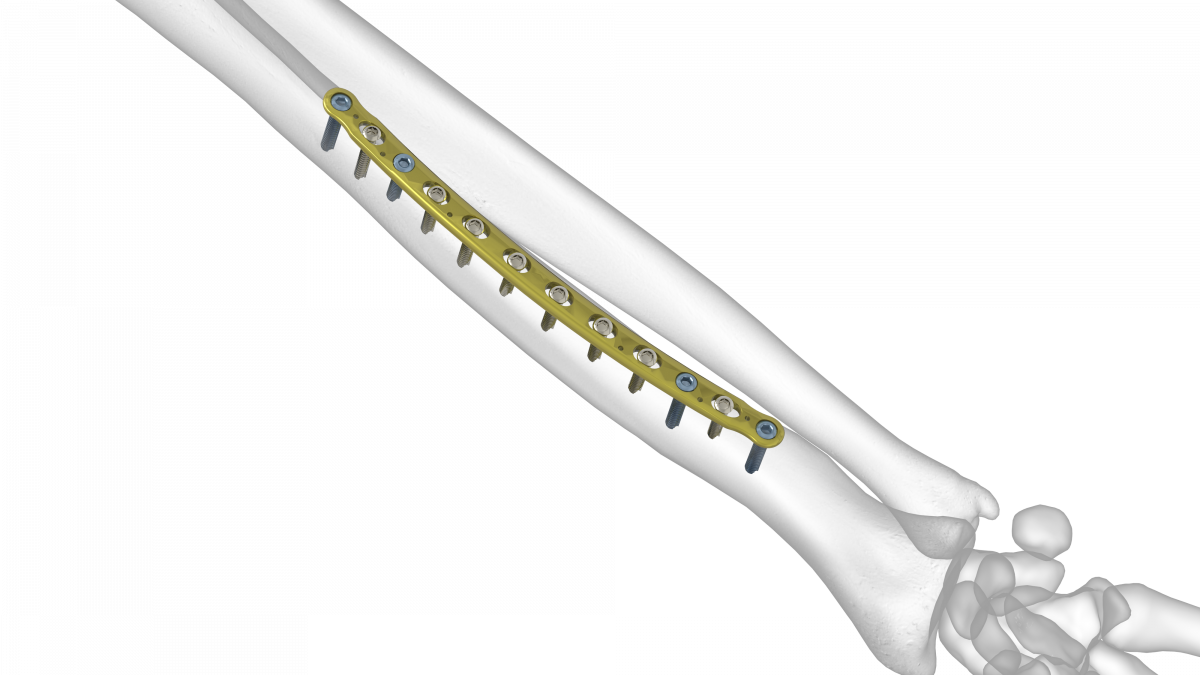 Midshaft Volar Radius Plate | Acumed