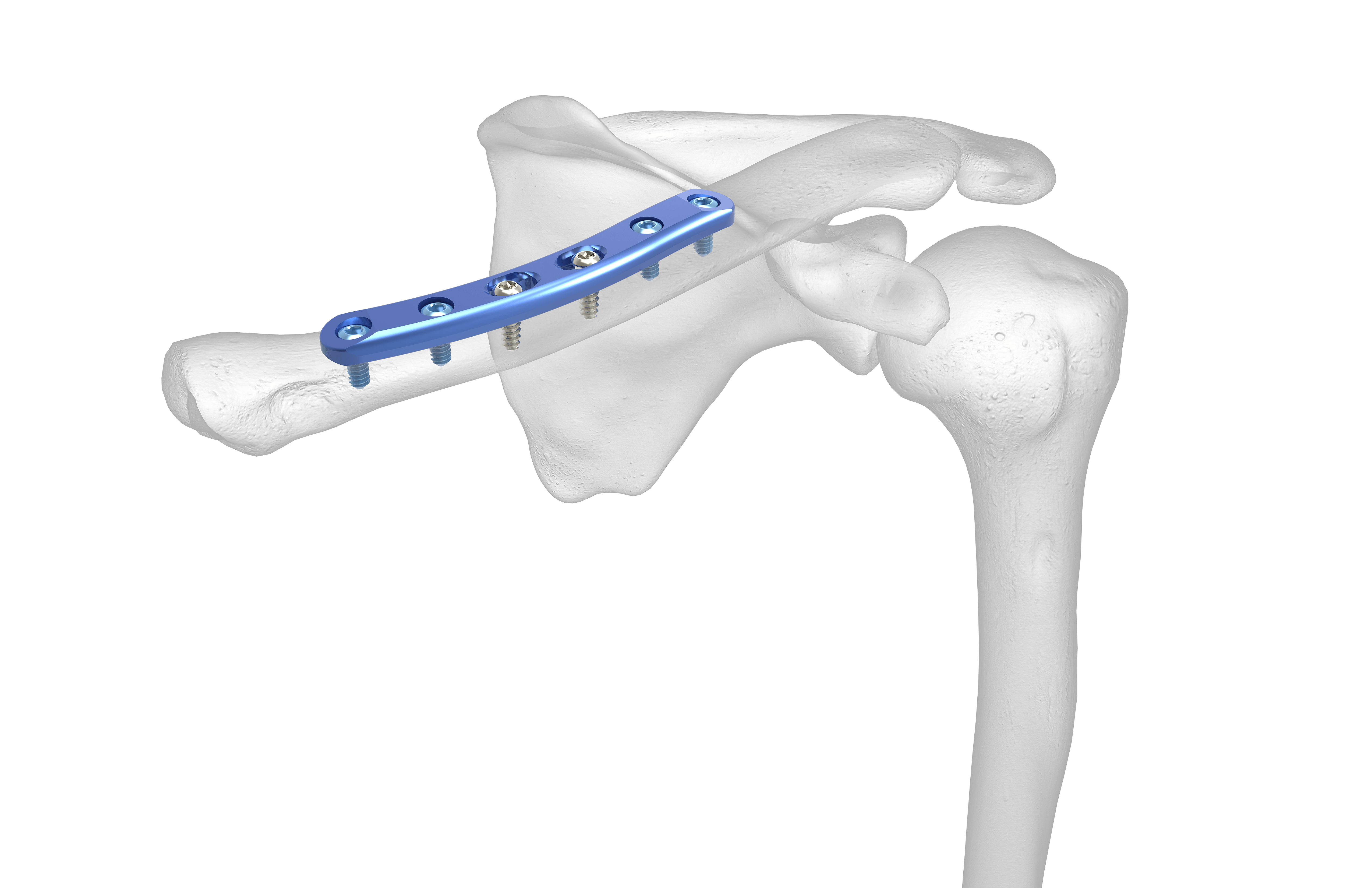 clavicle-plating-system-acumed