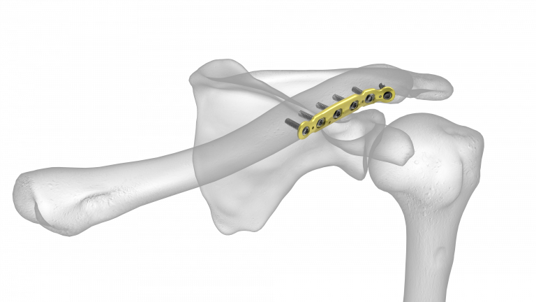 Anterior Clavicle Plate | Acumed