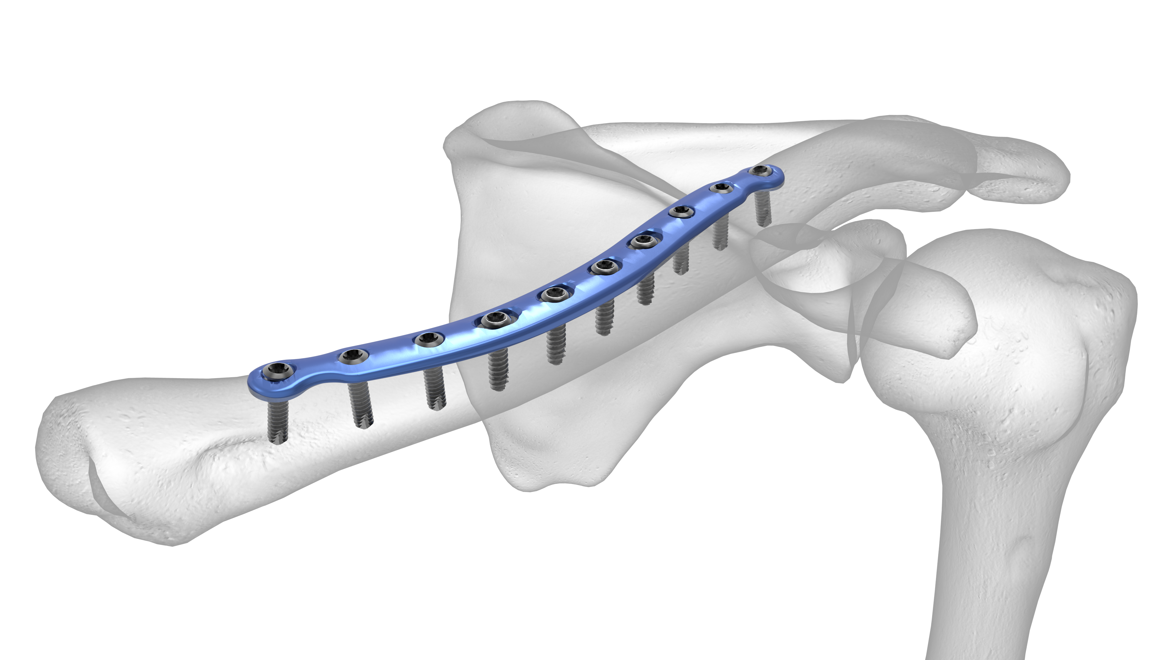 midshaft-clavicle-plate-acumed