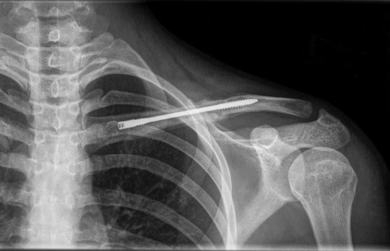 Dual-Trak Clavicle Plating System | Acumed