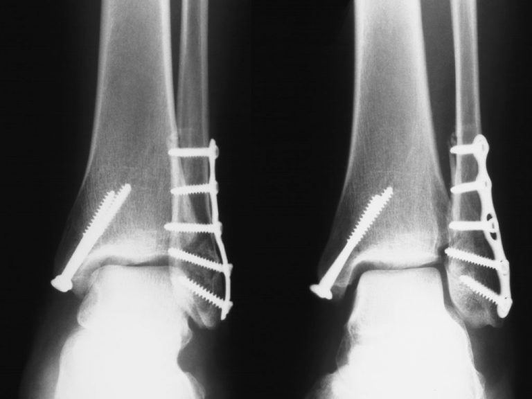 Locking Ankle Plate System Acumed