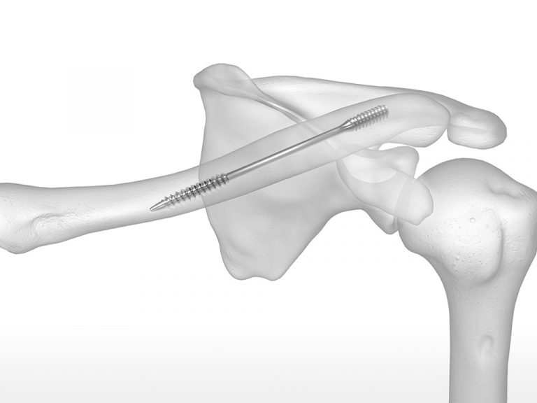 Dual-Trak Clavicle Screw System | Acumed