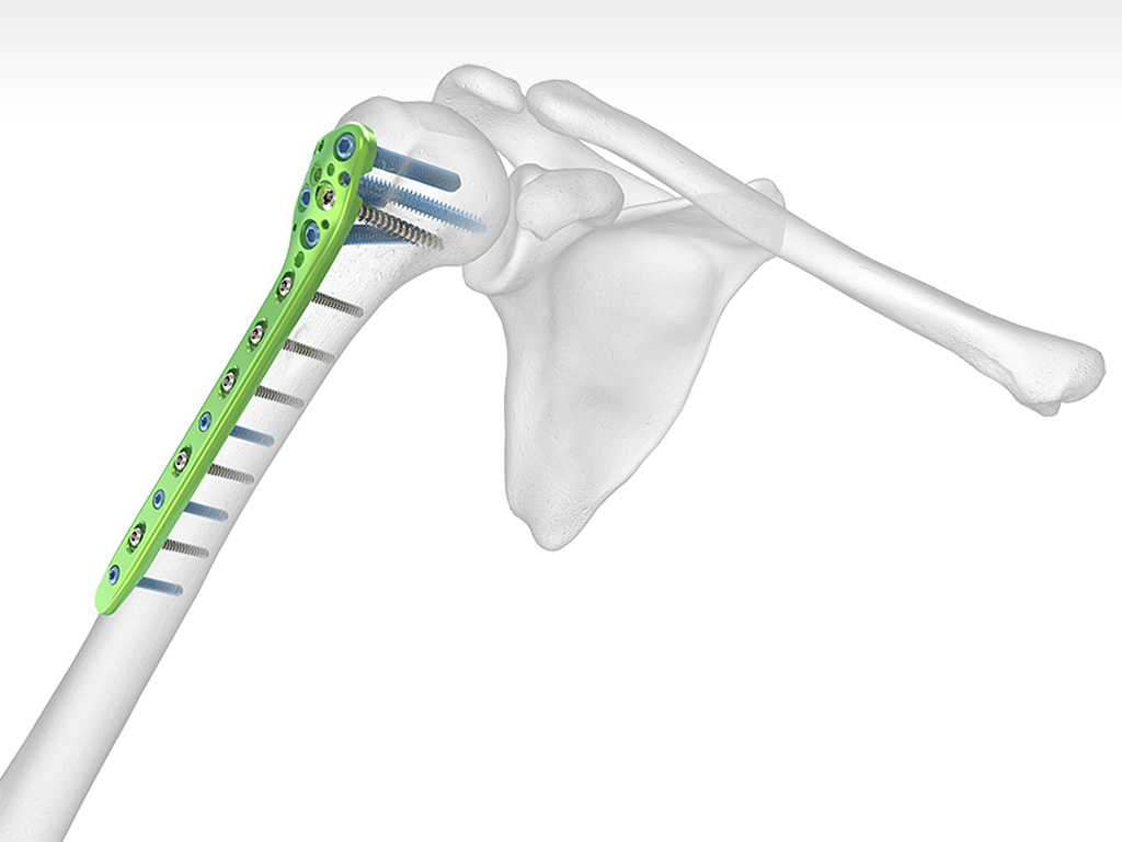 Polarus Proximal Humeral Plating (PHP) System | Acumed