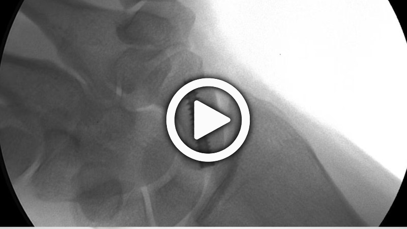 Scaphoid Approach To Dorsal Fixation Using Acutrak 2 Screw With Dr