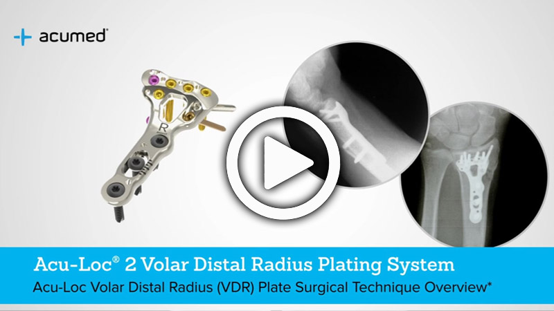 Acu Loc 2 Volar Distal Radius Plate Surgical Technique Overview