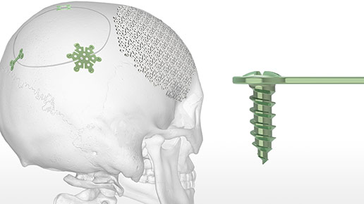 OsteoMed InstaFix Shape Memory Fixation System