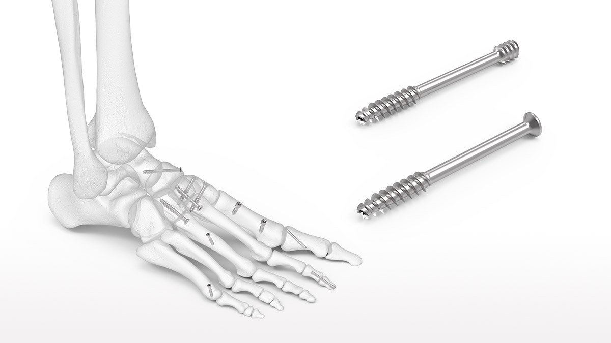 OsteoMed M3-X Extremity Fixation System