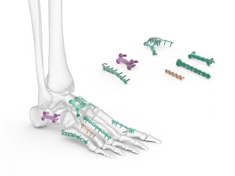 FPS Foot Plating System | Acumed