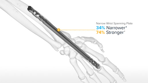 Acu-Loc Wrist Spanning Plate